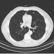 Image of lungs from a low-does CT scan