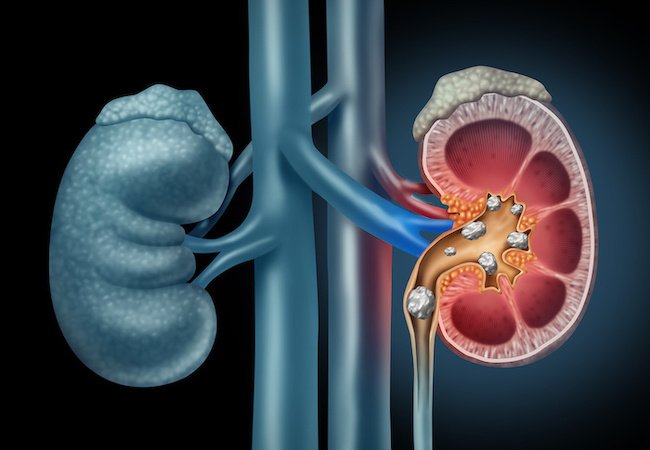 Two Williamsburg Urologists Change the Way Kidney Stones are Treated