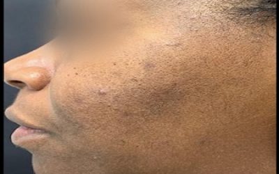 Post-Inflammatory Hyperpigmentation