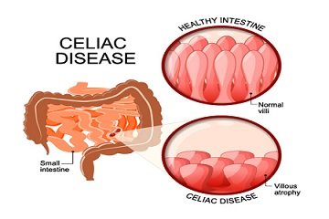 What You Need to Know About Celiac Disease