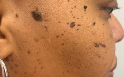 DPNs: This Sign of Aging is Nothing to Fear