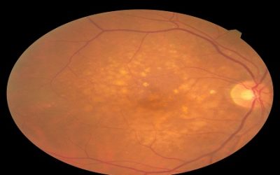 Macular Degeneration FAQs