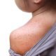 Child with shirt pulled down to expose shoulder with red bumps, skin rash